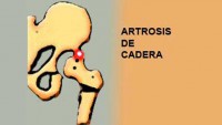 artrosis-sintomas