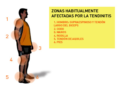 La tendinitis: ¿En qué consiste?